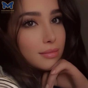 rhinoplasty-selfie-2