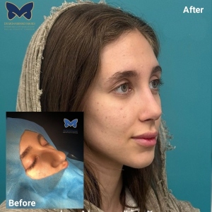 rhinoplasty-ba-1