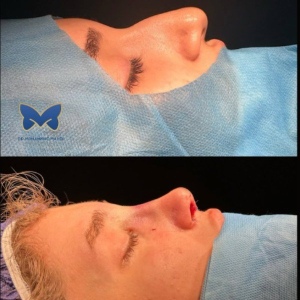 rhinoplasty-ba-2