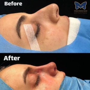 rhinoplasty-ba-3