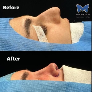 rhinoplasty-ba-4
