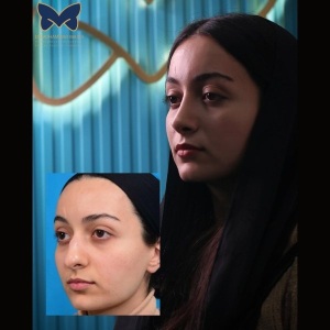 rhinoplasty-ba-6