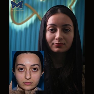 rhinoplasty-ba-7