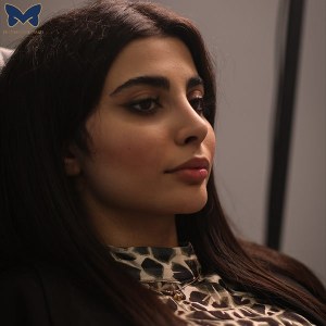 جراحی-بینی-استخوانی-12