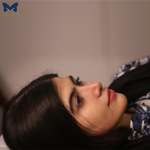 جراحی-بینی-استخوانی-17