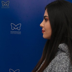 جراحی-بینی-استخوانی-2