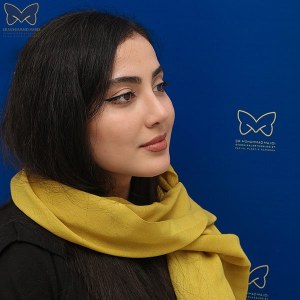 جراحی-بینی-استخوانی-21