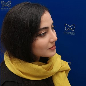 جراحی-بینی-استخوانی-22