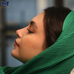 جراحی-بینی-استخوانی-28