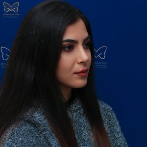 جراحی-بینی-استخوانی-3