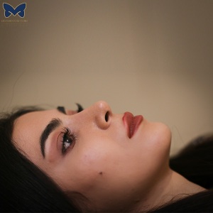 جراحی-بینی-استخوانی-6