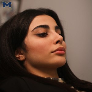 جراحی-بینی-استخوانی-8