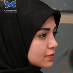 thin-skin-nose-rhinoplasty-50