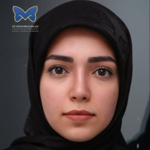 thin-skin-nose-rhinoplasty-51