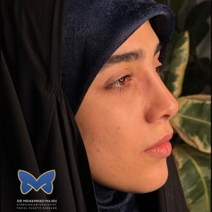 thin-skin-nose-rhinoplasty-56