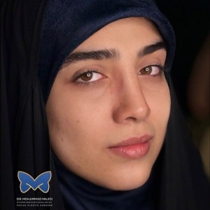 thin-skin-nose-rhinoplasty-57