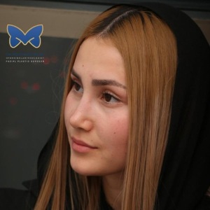 thin-skin-nose-rhinoplasty-60