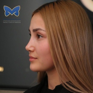 thin-skin-nose-rhinoplasty-61