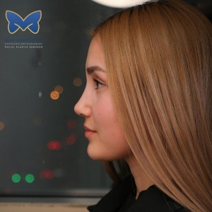 thin-skin-nose-rhinoplasty-62