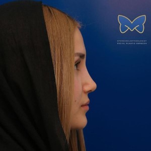 thin-skin-nose-rhinoplasty-63