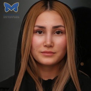thin-skin-nose-rhinoplasty-64