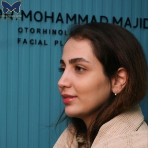 thick-skin-nose-rhinoplasty-20
