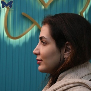 thick-skin-nose-rhinoplasty-21