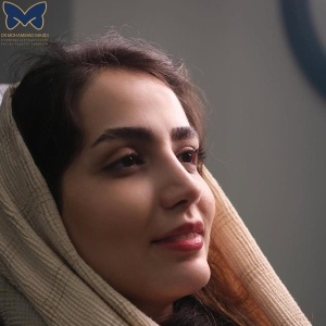 thick-skin-nose-rhinoplasty-22