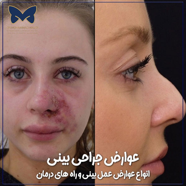 عوارض جراحی بینی