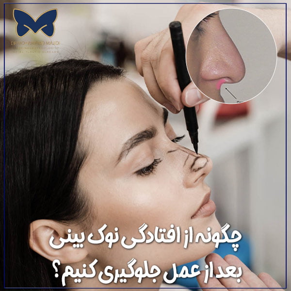 افتادگی نوک بینی بعد از عمل