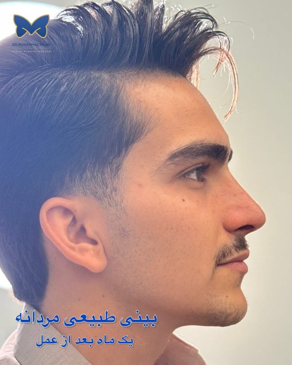قبل و بعد از عمل بینی گوشتی مردانه