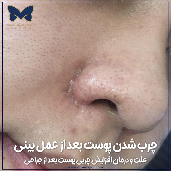 چرب شدن پوست بعد از عمل بینی