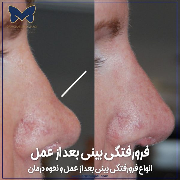 فرورفتگی بینی بعد از عمل