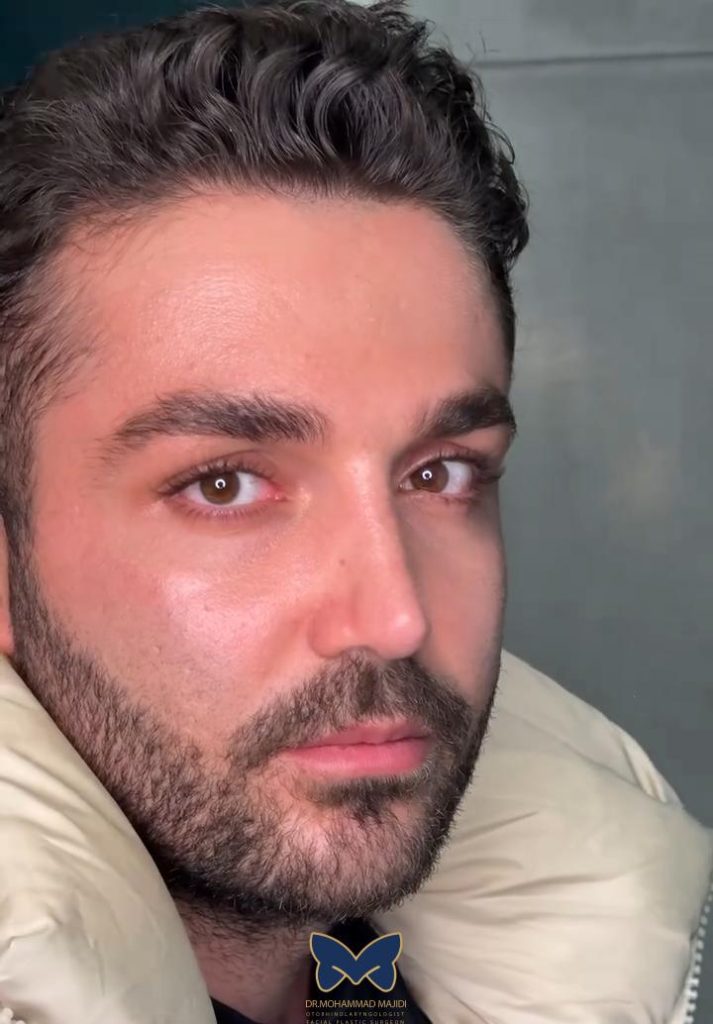 جراحی بینی استخوانی مردانه