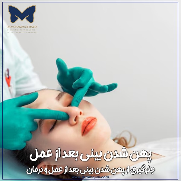 پهن شدن بینی بعد از عمل