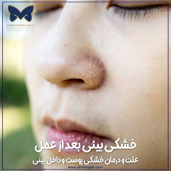 خشکی بینی بعد از عمل
