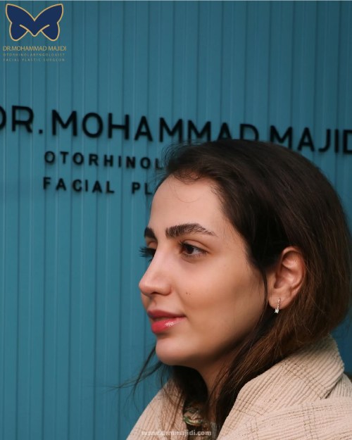 عکس عمل بینی گوشتی طبیعی