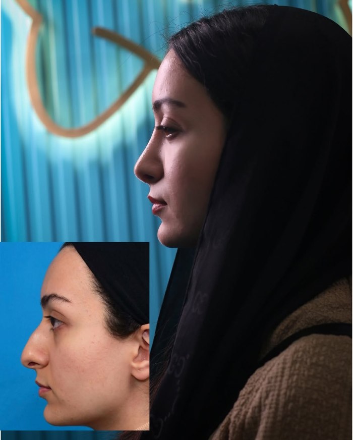 عکس عمل بینی استخوانی