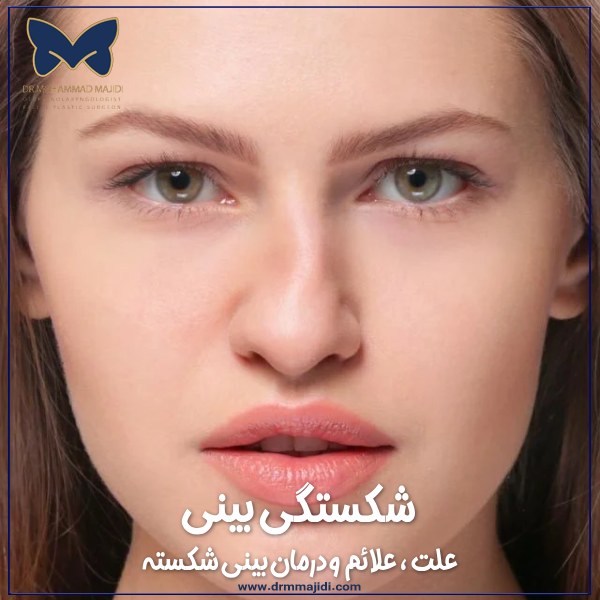شگستگی بینی