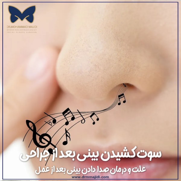 سوت کشیدن بینی بعد از جراحی