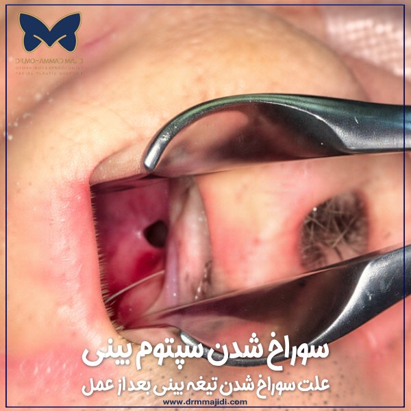 عکس سوراخ شدن سپتوم بینی