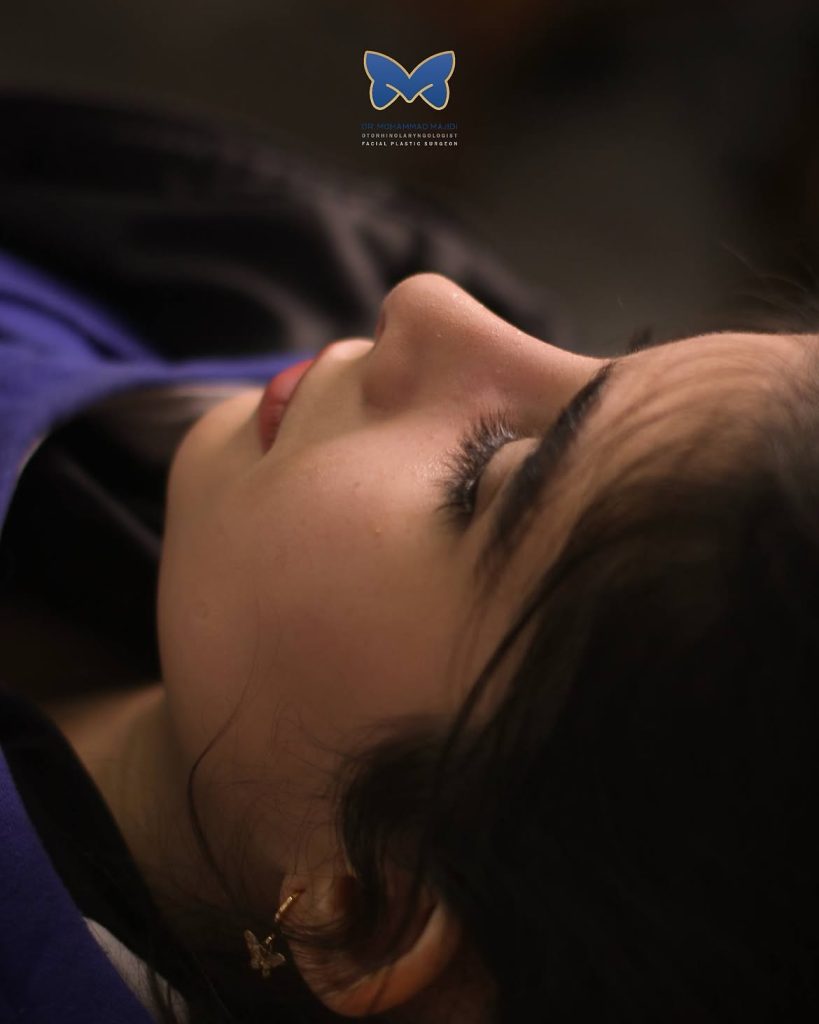 نمونه کار جراحی بینی استخوانی زنانه