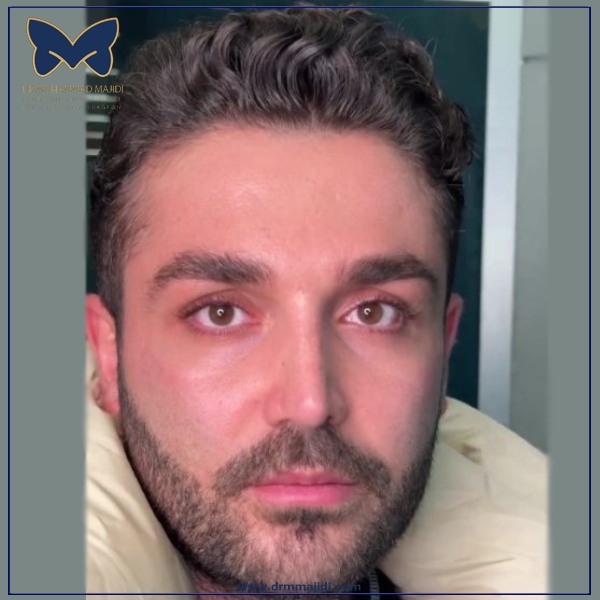 عکس عمل بینی مردانه