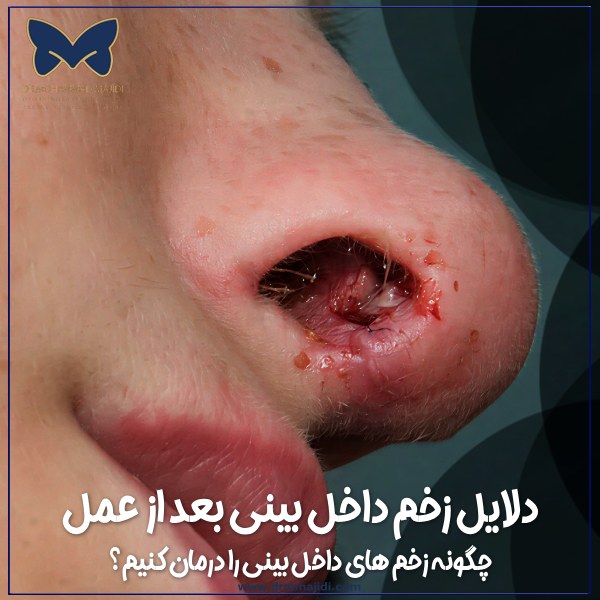 عکس زخم داخل بینی بعد از عمل