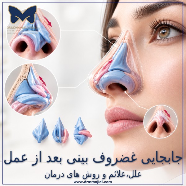 جابجایی غضروف بینی بعد از عمل