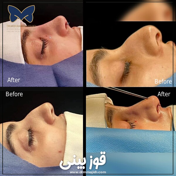 قوز بینی ؛ روش اصلاح قوز بینی با جراحی